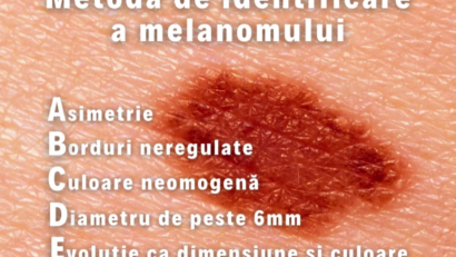 Asociaţia Melanom România continuă să mobilizeze actorii din sănătate pentru îmbunătăţirea îngrijirii pacienţilor cu melanom!