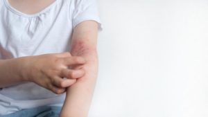 APAA lansează o campanie de informare despre dermatita atopică